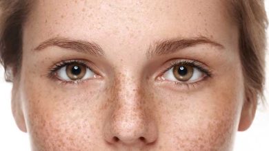 درمان لکه های قهوه ای صورت در طب سنتی