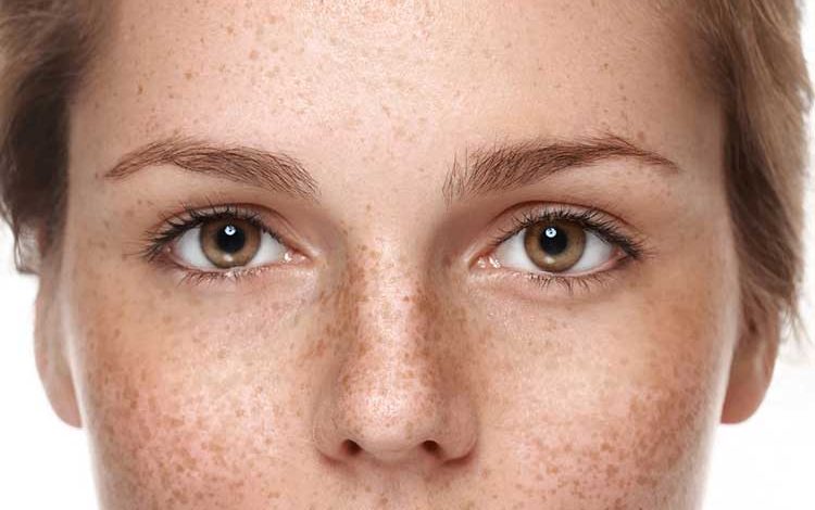 درمان لکه های قهوه ای صورت در طب سنتی