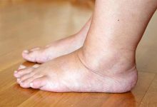 لیست کامل داروهایی که باعث احتباس آب در بدن میشود